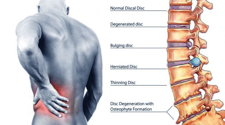 Best Physiotherapy clinic in Cairo for Herniated disc treatment