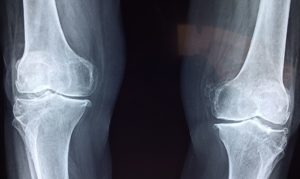 How to Find Clinic to Treatment knee Osteoarthritis in Sheikh Zayed, Egypt