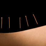 Best Dry Needling Therapy treatment in Egypt - Sheikh zayed - Nasr city - New cairo