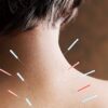 افضل مركز دكتور علاج الرقبة بالابر الصينية في مصر – بدون جراحة - Image 3
